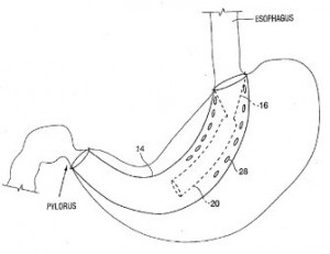 gastro-esophageal implants