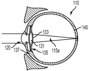 intra-ocular device