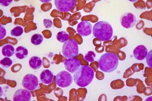 15271-microscopic-view-of-blast-crisis-of-chronic-myelogenous-leukemia-pv